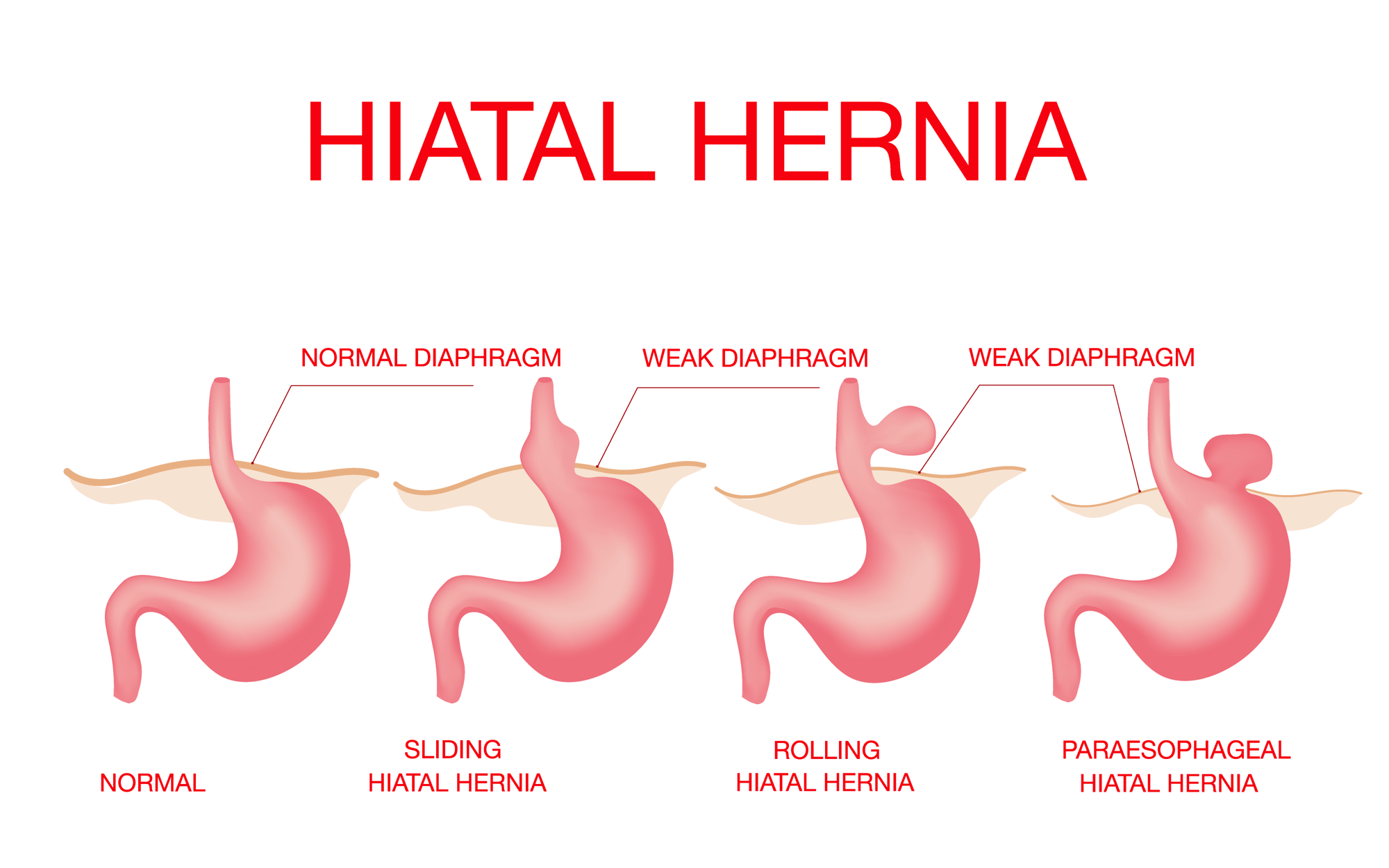 sliding type hiatal hernia